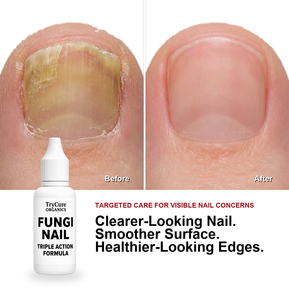 Before-and-after comparison of yellow, rough, brittle, and uneven toenail appearance.